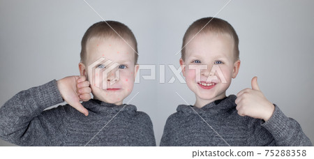 Before and after. The child shows a face with a lot of red allergic acne. The second picture shows a clean face without any allergies. The concept of the treatment of children's rashes. Chickenpox 75288358