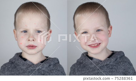 Before and after. The child shows a face with a lot of red allergic acne. The second picture shows a clean face without any allergies. The concept of the treatment of children's rashes. Chickenpox 75288361