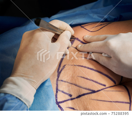 Surgeon hands doing plastic surgery in operating room. 75288395