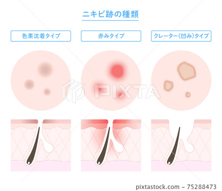 痤瘡疤痕類型和皮膚橫斷面插圖 75288473