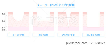 火山口型痤瘡疤痕類型和皮膚橫斷面插圖 75288474
