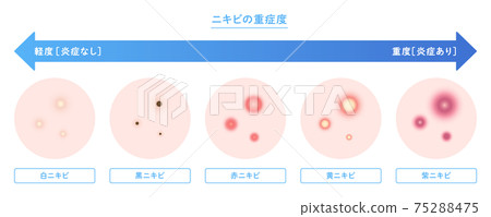 痤瘡類型和嚴重性說明 75288475