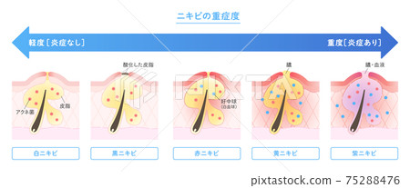 皮膚截面中顯示的痤瘡類型和嚴重程度說明 75288476