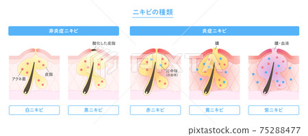 皮膚橫截面中顯示的痤瘡類型插圖 75288477