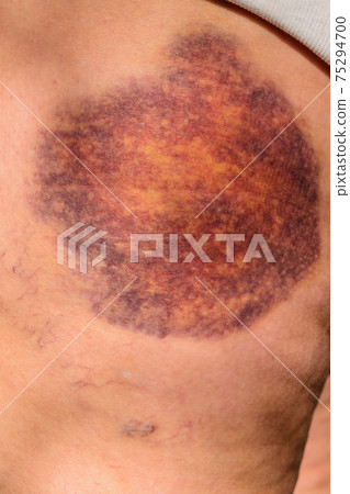 Close-up of a woman's legs old with a big bruise after falling on ice in the winter 75294700