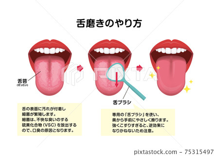 How to brush and clean your tongue Vector illustration (prevention of bad breath) 75315497