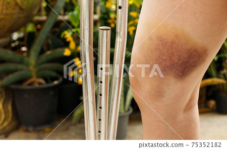 Hematoma and Large Bruise, blood under skin Congestion Hematoma and Large Bruise, blood under skin Congestion 75352182