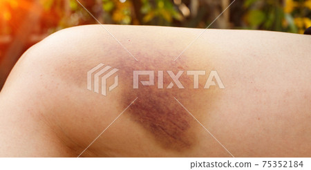 Hematoma and Large Bruise, blood under skin Congestion Hematoma and Large Bruise, blood under skin Congestion 75352184