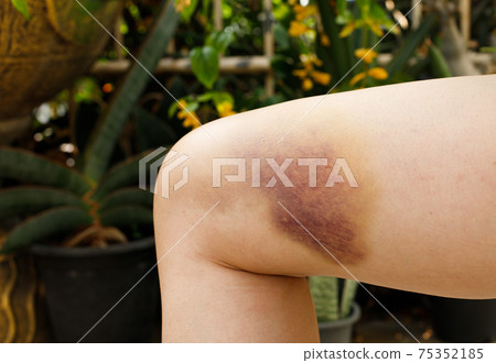Hematoma and Large Bruise, blood under skin Congestion Hematoma and Large Bruise, blood under skin Congestion 75352185
