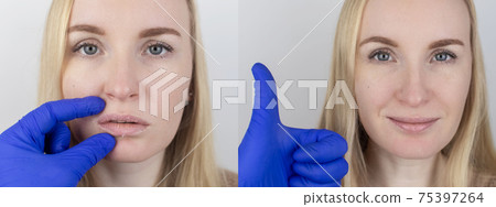 Before and after. A woman examines dry skin on her lips. Peeling, coarsening, discomfort, skin sensitivity. Patient at the appointment of a dermatologist or cosmetologist. Close-up of pieces of dry Before and after. A woman examines dry skin on her lips. Peeling, coarsening, discomfort, skin sensitivity. Patient at the appointment of a dermatologist or cosmetologist. Close-up of pieces of dry 75397264