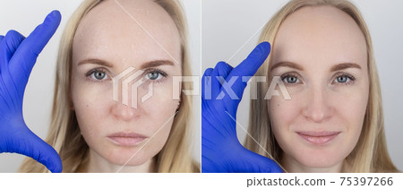 Before and after. A woman examines dry skin on her face. Peeling, coarsening, discomfort, skin sensitivity. Patient at the appointment of a dermatologist or cosmetologist. Close-up of pieces of dry 75397266