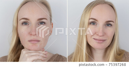 Before and after. A woman examines dry skin on her face. Peeling, coarsening, discomfort, skin sensitivity. Patient at the appointment of a dermatologist or cosmetologist. Close-up of pieces of dry Before and after. A woman examines dry skin on her face. Peeling, coarsening, discomfort, skin sensitivity. Patient at the appointment of a dermatologist or cosmetologist. Close-up of pieces of dry 75397268