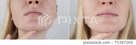 Before and after. A woman examines dry skin on her face. Peeling, coarsening, discomfort, skin sensitivity. Patient at the appointment of a dermatologist or cosmetologist. Close-up of pieces of dry Before and after. A woman examines dry skin on her face. Peeling, coarsening, discomfort, skin sensitivity. Patient at the appointment of a dermatologist or cosmetologist. Close-up of pieces of dry 75397269