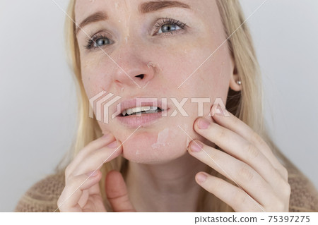 A woman examines dry skin on her face. Peeling, coarsening, discomfort, skin sensitivity. Patient at the appointment of a dermatologist or cosmetologist. Close-up of pieces of dry skin 75397275