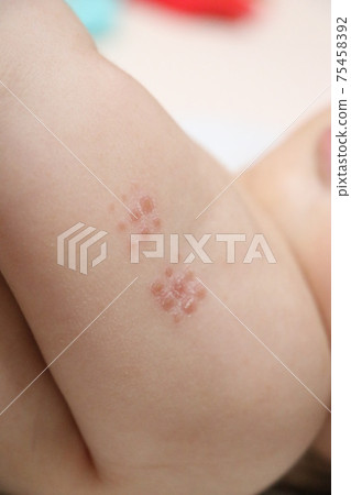 BCG injected baby's arm (0 years old, 6 months old, girl, Japanese) 75458392