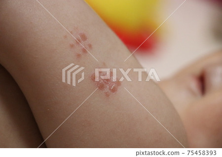 BCG injected baby's arm (0 years old, 6 months old, girl, Japanese) 75458393