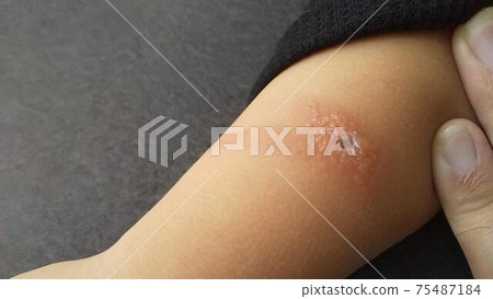 Swelling / insect bites (burn insects) Swelling / insect bites (burn insects) 75487184