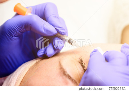 Miliums on the face, removal of hardened and mature milia by a beautician. Miliums on the face, removal of hardened and mature milia by a beautician. 75509381