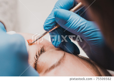 Milium on the face, removal of milia with a syringe in cosmetology. 75509382