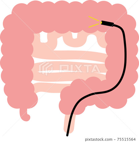 內窺鏡結腸鏡檢查 內窺鏡結腸鏡檢查 75515564