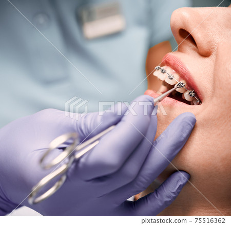 Orthodontist hands placing braces on woman teeth. 75516362