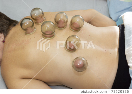 Medical jars for vacuum therapy on back of patient woman 75520526