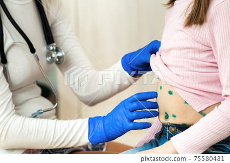 Doctor examining a child covered with green rashes on stomach ill with chickenpox, measles or rubella virus. 75580481