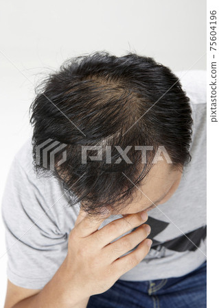 中年男子因脫髮而承受壓力 中年男子因脫髮而承受壓力 75604196