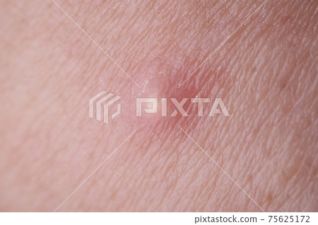 Pimple with purulent discharge on skin closeup Pimple with purulent discharge on skin closeup 75625172