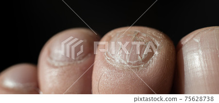 Close-up of male toes with a cracked nail Close-up of male toes with a cracked nail 75628738