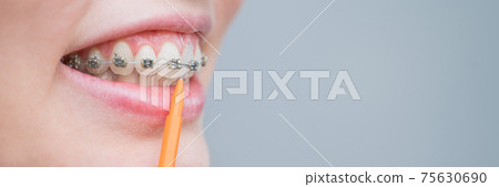 Unrecognizable Caucasian woman cleans braces with a brush. Close-up of female teeth with brackets. Wide screen Unrecognizable Caucasian woman cleans braces with a brush. Close-up of female teeth with brackets. Wide screen 75630690