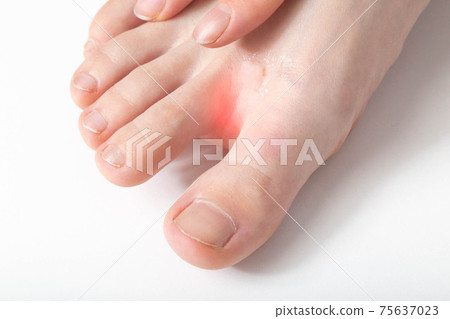 The girl applies a healing ointment between the toes against peeling and irritation of the skin, an unpleasant odor 75637023