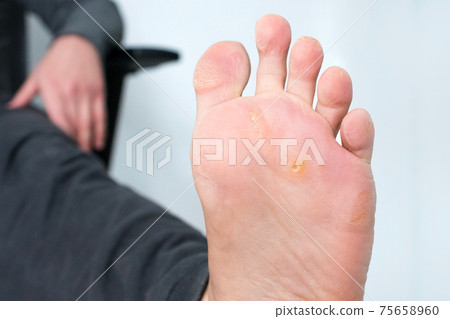 Foot with corns, calluses and dry skin, wart plantar verrucas. Verrucas papilloma callus virus, disease on foot skin. Unhealthy foot leg with corn close up. Man shows callosity before treatment Foot with corns, calluses and dry skin, wart plantar verrucas. Verrucas papilloma callus virus, disease on foot skin. Unhealthy foot leg with corn close up. Man shows callosity before treatment 75658960