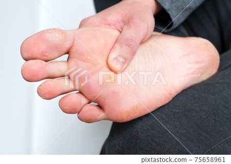 Foot with corns, calluses and dry skin, wart plantar verrucas. Verrucas papilloma callus virus, disease on foot skin. Unhealthy foot leg with corn close up. Man shows callosity before treatment 75658961