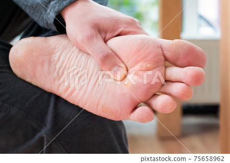 Foot with corns, calluses and dry skin, wart plantar verrucas. Verrucas papilloma callus virus, disease on foot skin. Unhealthy foot leg with corn close up. Man shows callosity before treatment 75658962