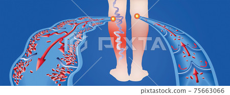 Varicose veins on a female senior legs. The structure of normal and varicose veins. Varicose veins on a female senior legs. The structure of normal and varicose veins. 75663066