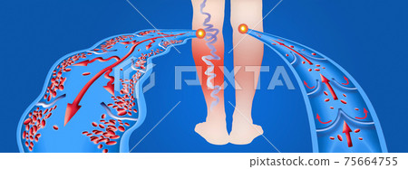 Varicose veins on a female senior legs. The structure of normal and varicose veins. 75664755