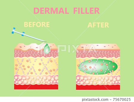 Cosmetic filler or dermal fillers 75670025