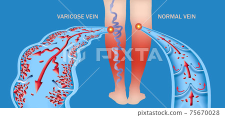 Varicose veins on a female senior legs. The structure of normal and varicose veins. Varicose veins on a female senior legs. The structure of normal and varicose veins. 75670028