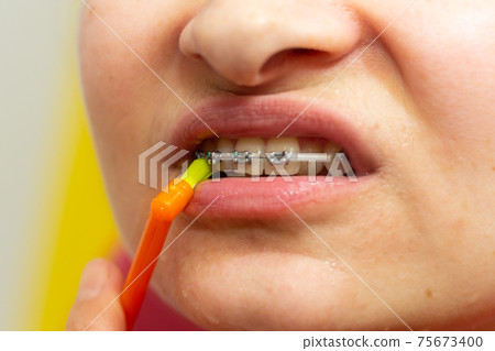 Girl with dental braces and brackets holding toothbrush for dental hygiene 75673400