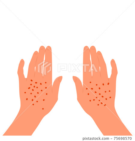 Red rash on the back of the female hands. Skin illness, allergy, inflammation. Isolated on white background. Flat style stock vector. 75698570