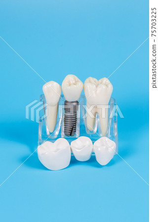 Dental crowns, imitation of a dental prosthesis of a dental bridge with implant 75703225