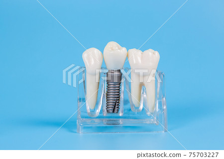 Dental crowns, imitation of a dental prosthesis of a dental bridge with implant Dental crowns, imitation of a dental prosthesis of a dental bridge with implant 75703227