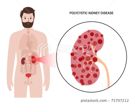 Kidney disease concept Kidney disease concept 75707212