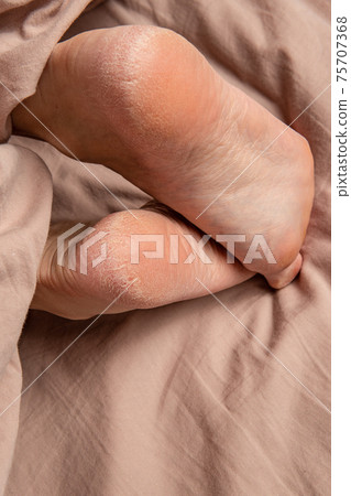 heel in the cracks of the smears on the legs woman crack care, lotion skin heel dry burrs, sole callosity. Dehydration pedicure, defect heel in the cracks of the smears on the legs woman crack care, lotion skin heel dry burrs, sole callosity. Dehydration pedicure, defect 75707368