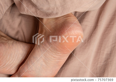 heel in the cracks of the smears on the legs dermatology treatment care, person fungus burrs, moisturizer. Dehydration cure heel in the cracks of the smears on the legs dermatology treatment care, person fungus burrs, moisturizer. Dehydration cure 75707369