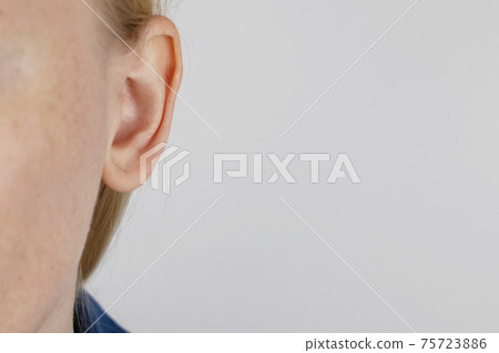 Darwin's tubercle on the ear. The girl at the reception at the plastic surgeon, shows the auricle. 75723886
