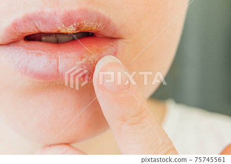 Close up of girl lips affected by herpes. Treatment of herpes infection and virus. Part of young woman face with finger touching pain on lips with herpes affected. Beauty dermatology concept. 75745561
