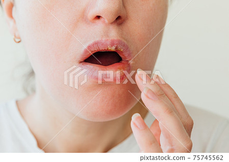 Close up of girl lips affected by herpes. Treatment of herpes infection and virus. Part of young woman face with finger touching pain on lips with herpes affected. Beauty dermatology concept. 75745562
