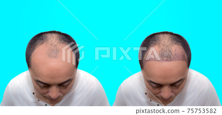 Close up top view of a man's head with hair transplant surgery with a receding hair line. before and after bald head of a man . Close up top view of a man's head with hair transplant surgery with a receding hair line. before and after bald head of a man . 75753582